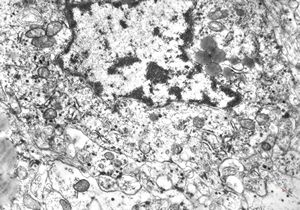 F,4y. | retroperitoneal neuroblastoma